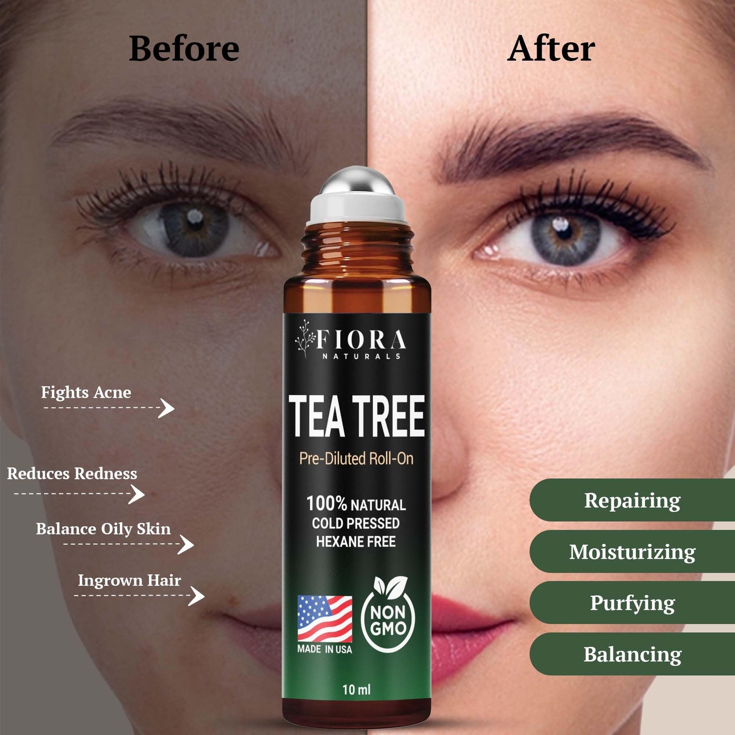 Tea Tree Oil – 100% Pure Organic Tea Tree Essential Oil for Skin, Face, Hair, Scalp, Nails, and Toenail – Therapeutic Grade Tree Tea Oil for Acne & Hair Growth – 1 fl oz - by Fiora Naturals